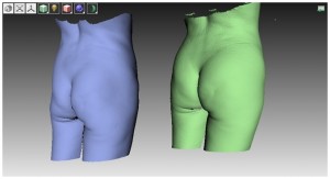 3D модели той же пациентки до и после липофилинга более наглядно, чем фото демонстрируют различия.