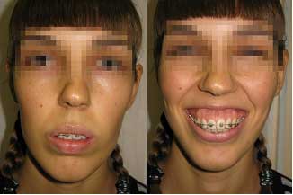 pic8 Рис Десневая улыбка