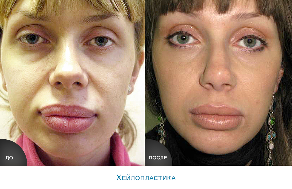 Убрать косточки на ногах операция цена