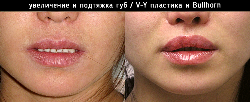 Расщепление губы и заячья губа