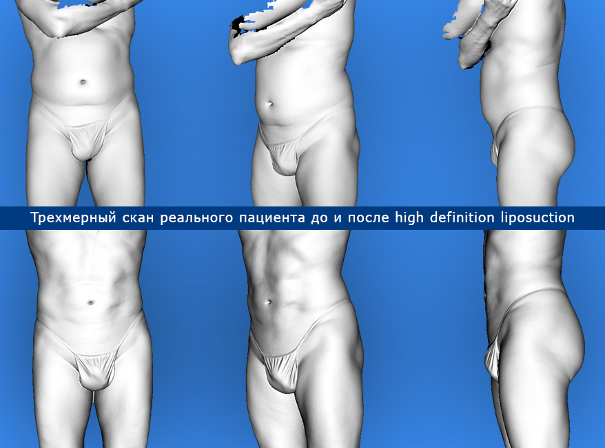 high definition liposuction